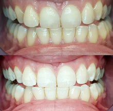 Afbeelding in Gallery-weergave laden, Tanden bleken