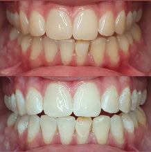 Afbeelding in Gallery-weergave laden, Tanden bleken
